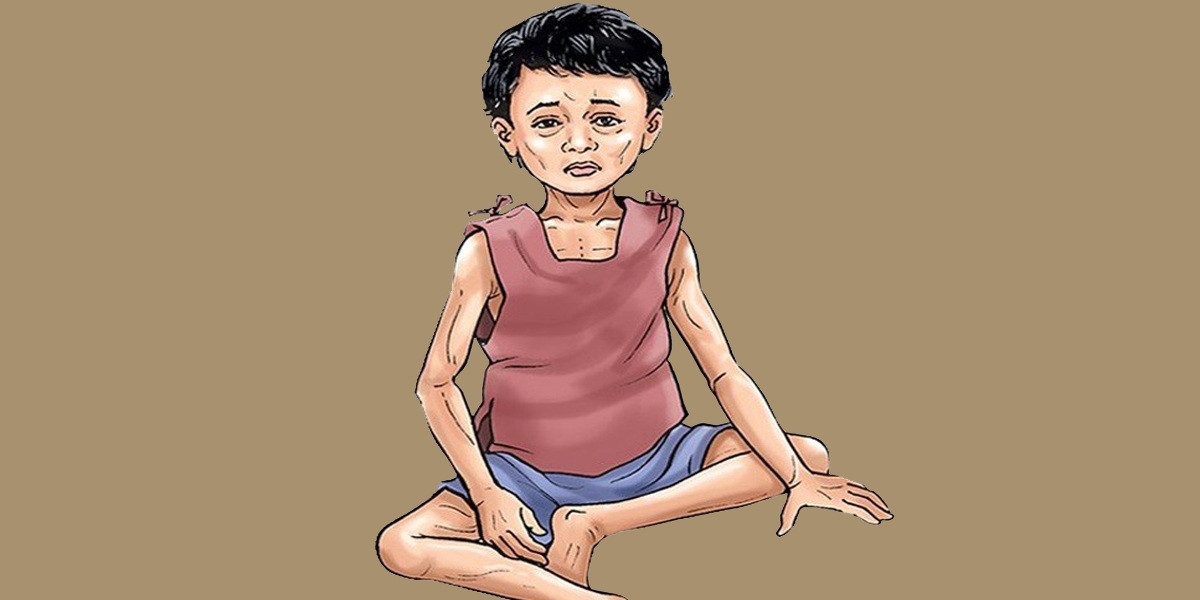पोषण लेखाजोखा : तीन सय ४७ बालबालिका कुपोषित