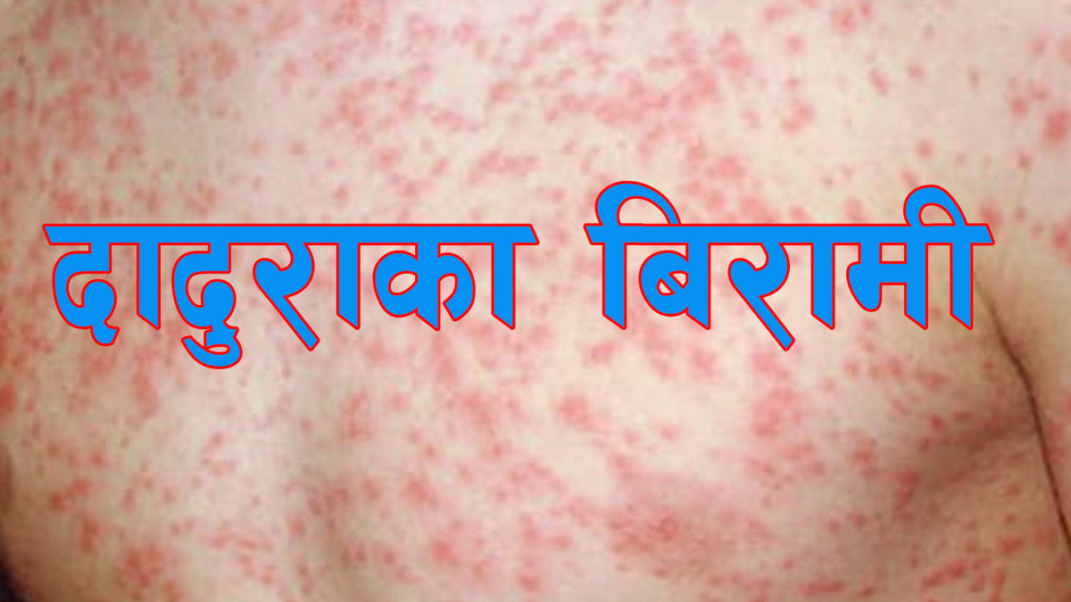 अझै नियन्त्रणमा आएन ढोरपाटनमा फैलिएको दादुरा सङ्क्रमण